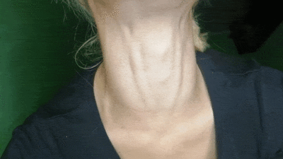 21062 - The veins on my throat